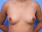 Patient # 36593 Before Photo # 1