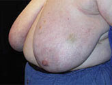 Patient # 77977 Before Photo # 1