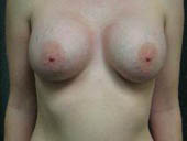 Patient # 44789 After Photo # 2