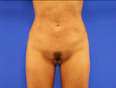 Patient # 34030 After Photo # 2