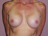 Patient # 36319 After Photo # 2