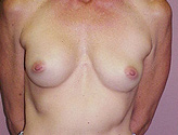 Patient # 36319 Before Photo # 1