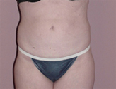 Patient # 96390 After Photo # 2