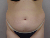 Patient # 96390 Before Photo # 1