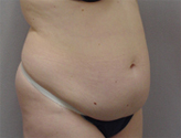 Patient # 96390 Before Photo # 3