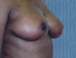 Patient # 70928 After Photo # 2
