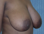 Patient # 70928 Before Photo # 1