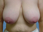 Patient # 55652 Before Photo # 1