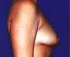 Patient # 41619 Before Photo # 1