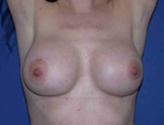 Patient # 65684 After Photo # 4