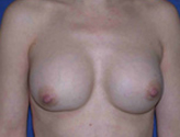Patient # 65684 Before Photo # 1