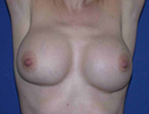 Patient # 65684 Before Photo # 3