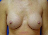 Patient # 22375 After Photo # 2