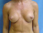 Patient # 97541 After Photo # 2