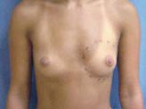 Patient # 26881 Before Photo # 1