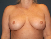 Patient # 98817 After Photo # 2