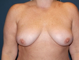 Patient # 98817 Before Photo # 1