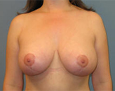 Patient # 47261 After Photo # 2