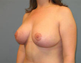 Patient # 47261 After Photo # 4