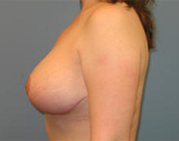 Patient # 47261 After Photo # 6