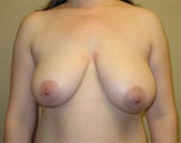 Patient # 47261 Before Photo # 1
