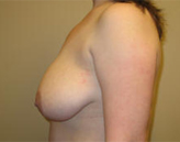 Patient # 47261 Before Photo # 5
