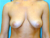 Patient # 20830 Before Photo # 1