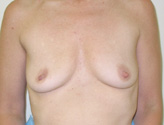 Patient # 76053 Before Photo # 1