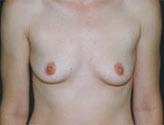 Patient # 29368 Before Photo # 1