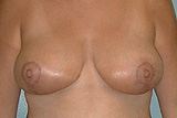 Patient # 44706 After Photo # 2