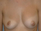 Patient # 21819 Before Photo # 1