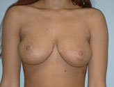 Patient # 83484 After Photo # 2
