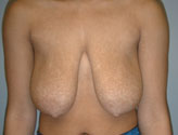 Patient # 83484 Before Photo # 1