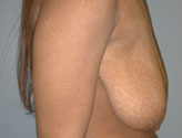 Patient # 83484 Before Photo # 3