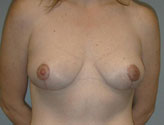 Patient # 66190 After Photo # 2