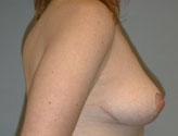Patient # 66190 After Photo # 4