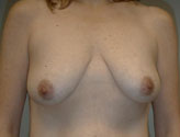 Patient # 66190 Before Photo # 1