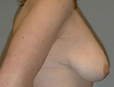 Patient # 66190 Before Photo # 3