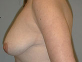 Patient # 66190 Before Photo # 5