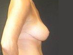 Patient # 36367 After Photo # 4