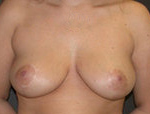 Patient # 54225 After Photo # 2