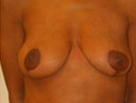 Patient # 14503 After Photo # 2