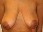 Patient # 14503 Before Photo # 1