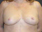 Patient # 89164 After Photo # 2