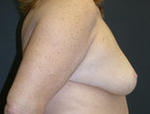 Patient # 89164 After Photo # 4
