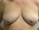 Patient # 89164 Before Photo # 1