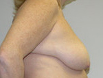 Patient # 89164 Before Photo # 3