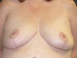 Patient # 24109 After Photo # 2
