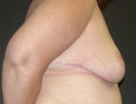 Patient # 24109 After Photo # 4
