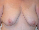 Patient # 24109 Before Photo # 1